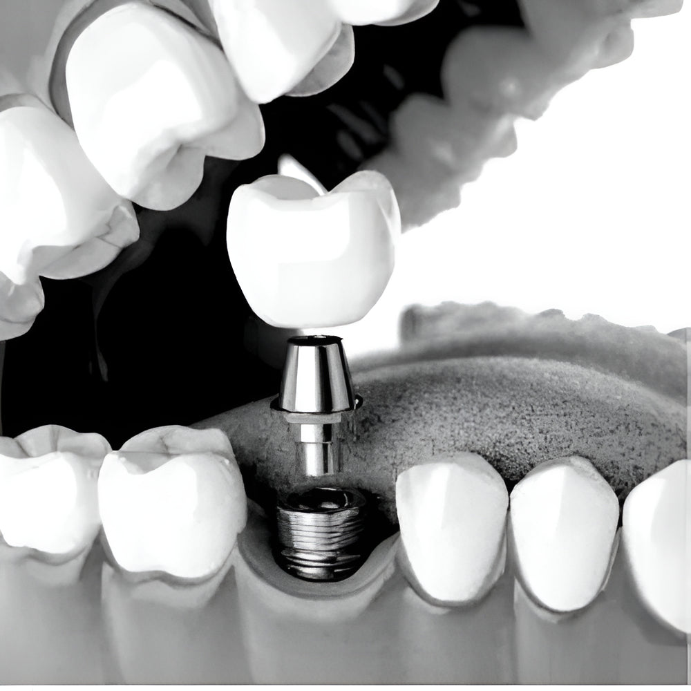 Implants