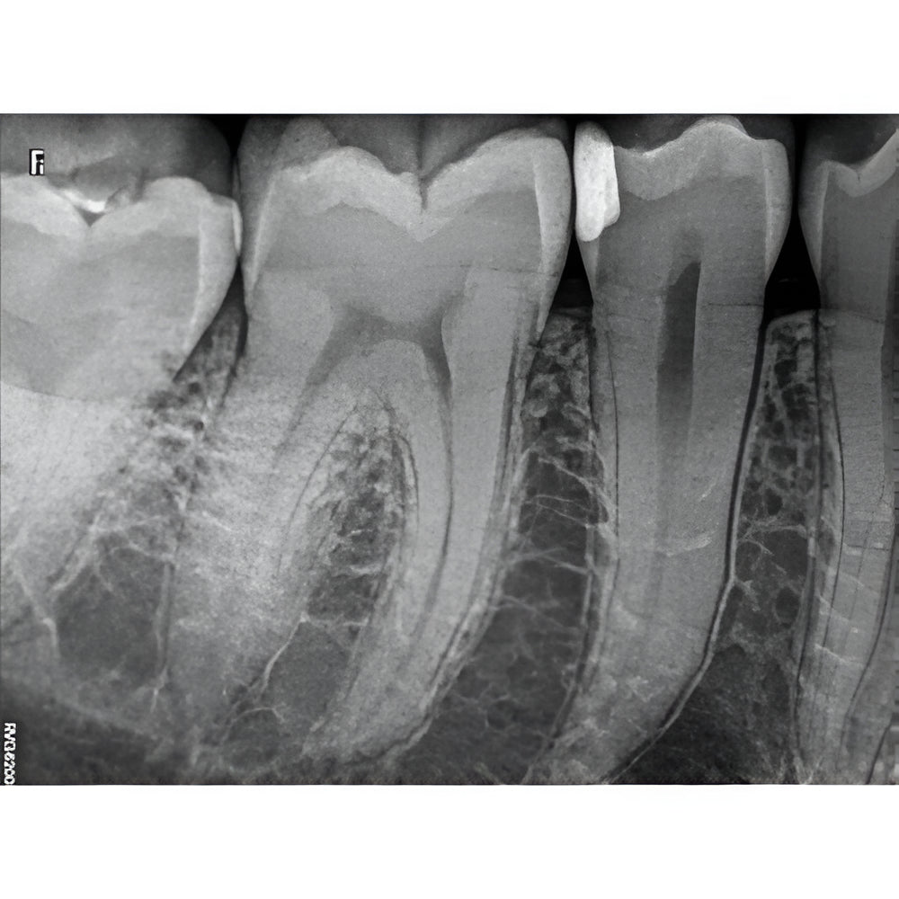 IntraOral Sensor