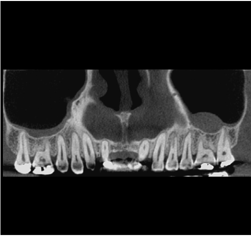 i-CAT FLX V17 Pan + CBCT (23x17 FOV)