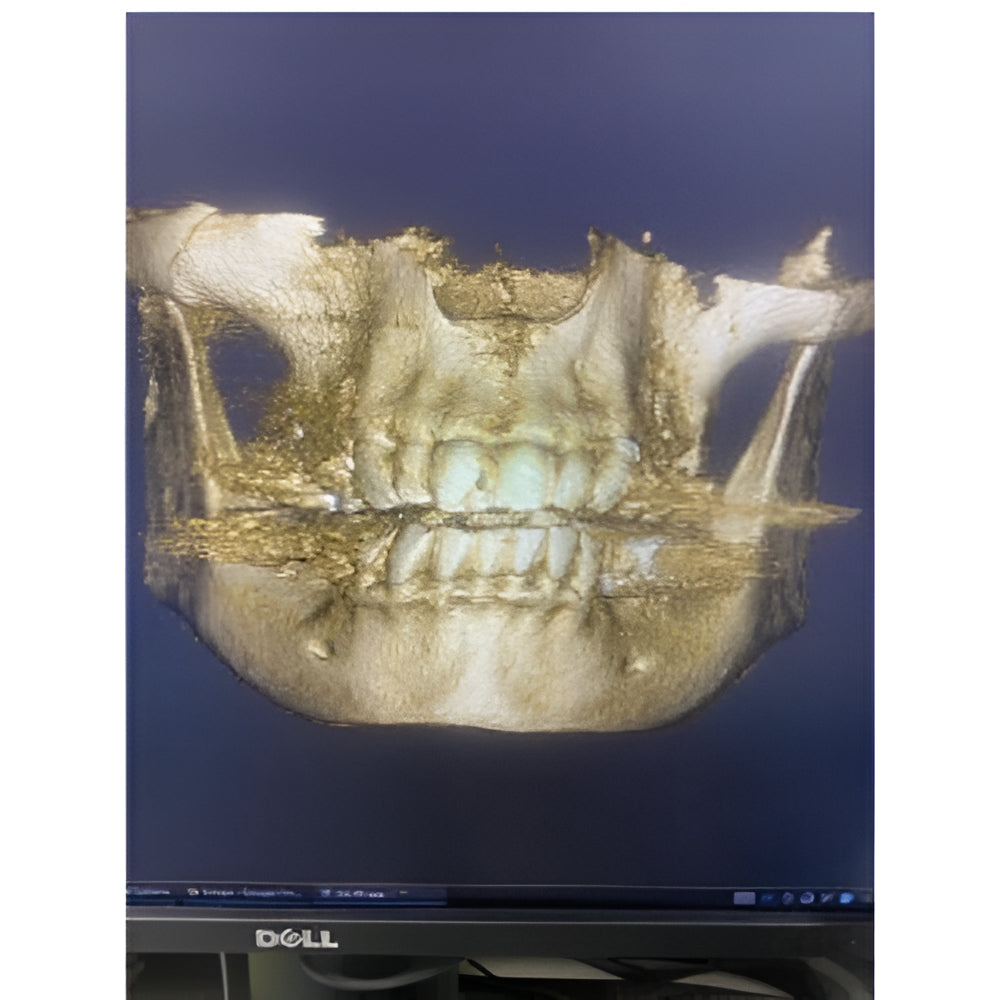 Acteon XMind Trium Pan + CBCT (11x8 FOV)