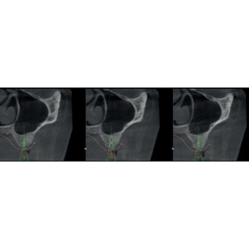 Acteon XMind Optima Pan + CBCT Wall Mount (12x10 FOV)