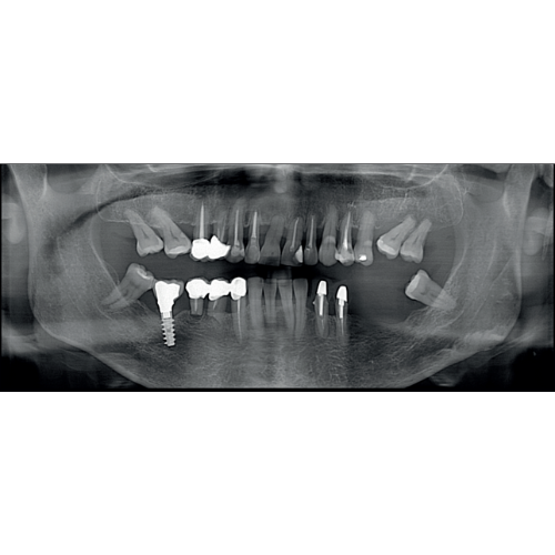 Acteon XMind Optima Pan + CBCT Wall Mount (12x10 FOV)