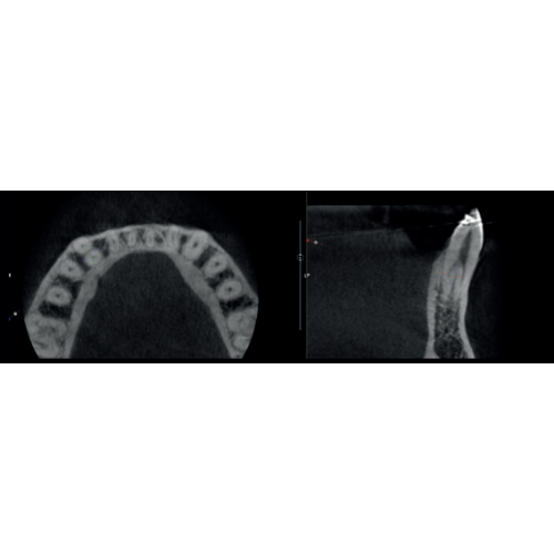 Acteon XMind Optima Pan + CBCT Wall Mount (12x10 FOV)