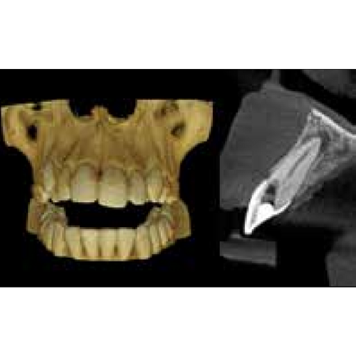 Carestream CS8100 Pan + CBCT (8x9 FOV)