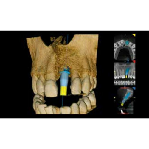 Carestream CS8100 Pan + CBCT (8x9 FOV)