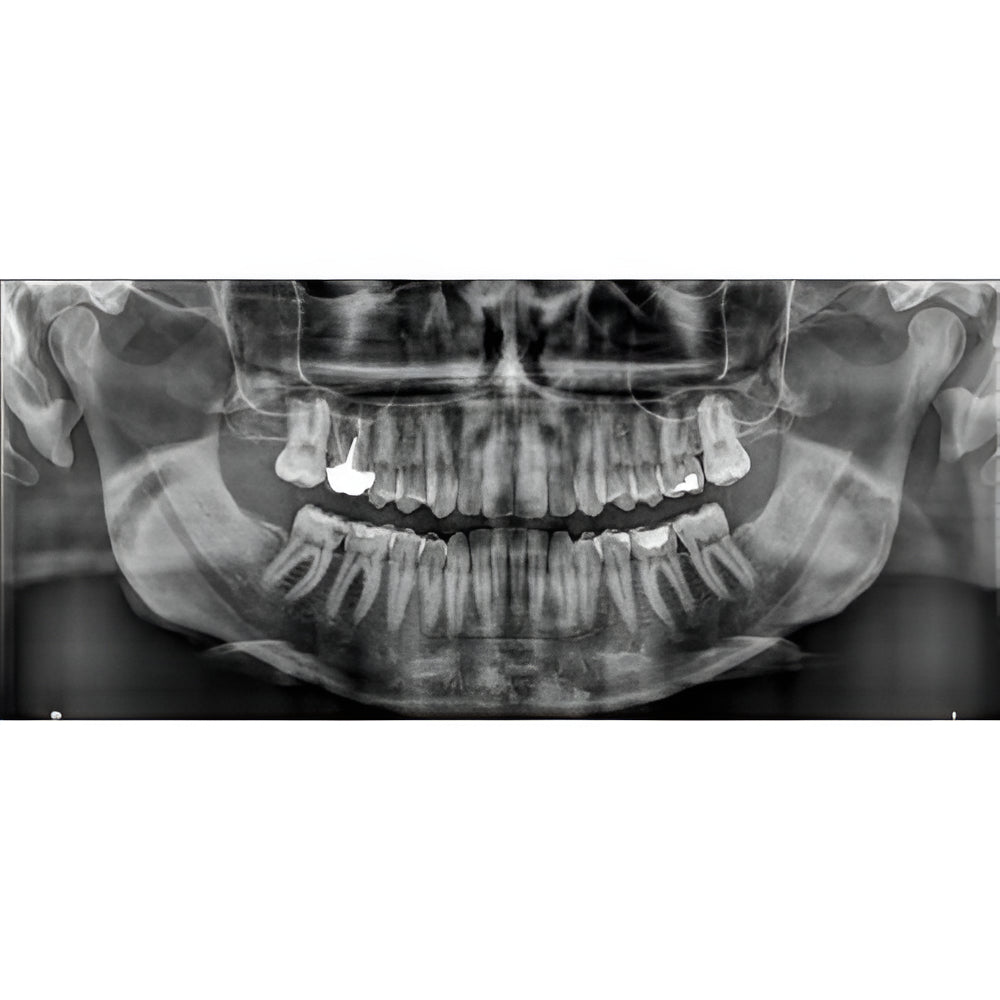 Carestream CS8100 Pan + CBCT (8x9 FOV)