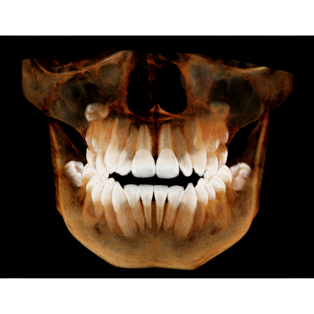 HDX Will Dentri Pan + CBCT