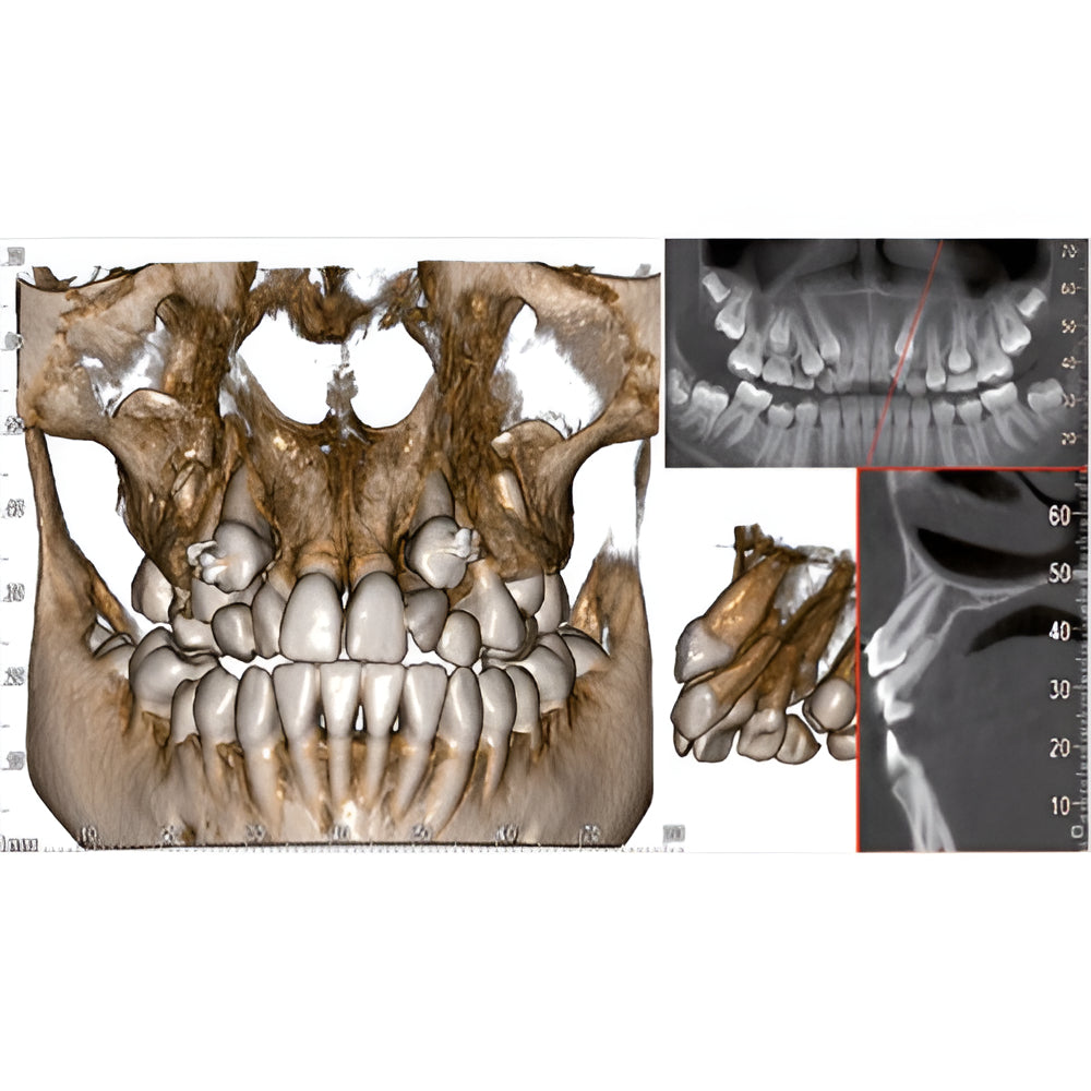 MyRay/Cefla Hyperion X5 Pan + CBCT (10x10 FOV)