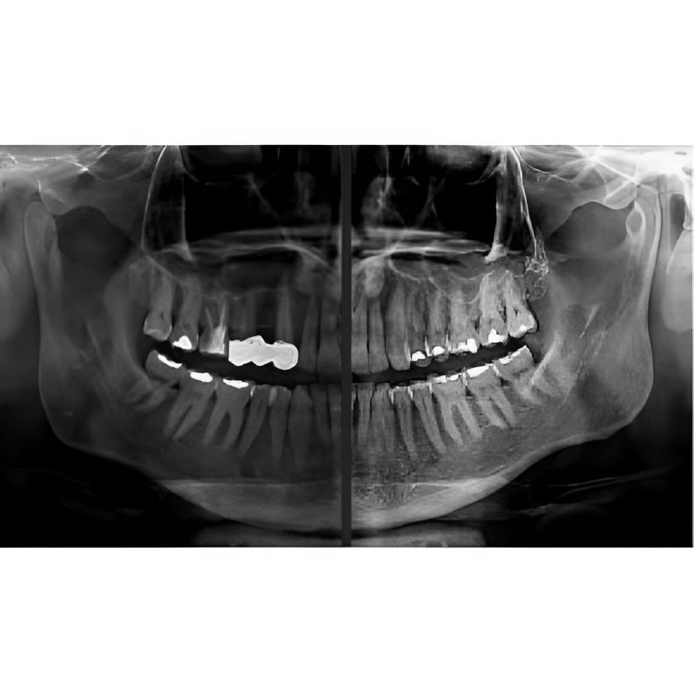 MyRay/Cefla Hyperion X9 PRO Pan + CBCT (13x16 FOV)