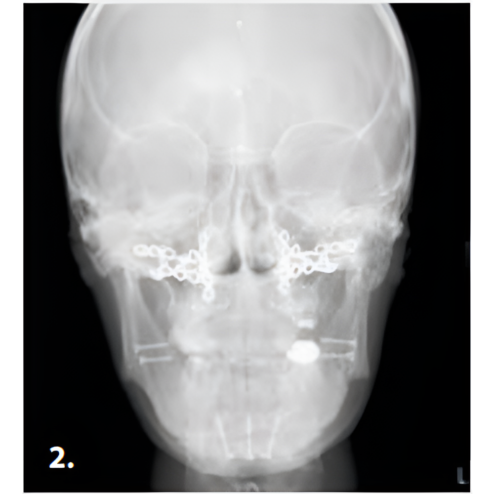 2021 MyRay/Cefla Hyperion X9 PRO Pan + Ceph + CBCT (13x16 FOV) with PC, Software, Installation, Shipping and Warranty
