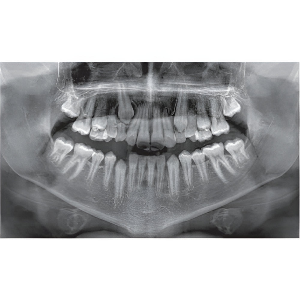 NewTom Giano Pan + Ceph + CBCT (11x8 FOV)