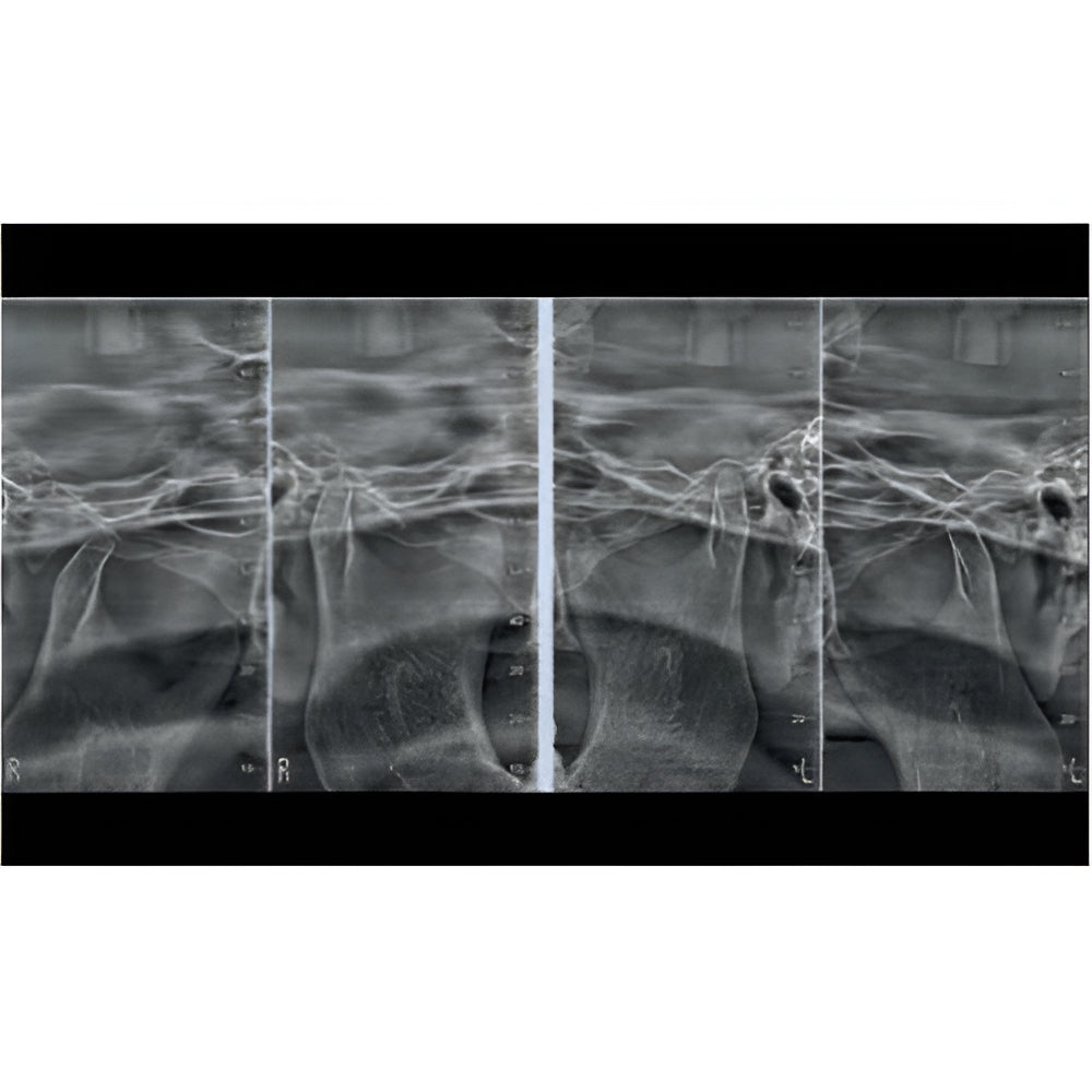 NewTom Giano Pan + Ceph + CBCT (11x8 FOV)
