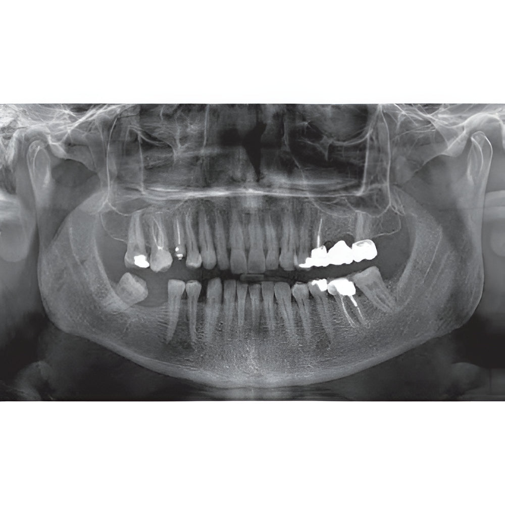 NewTom Giano Pan + Ceph + CBCT (11x8 FOV)