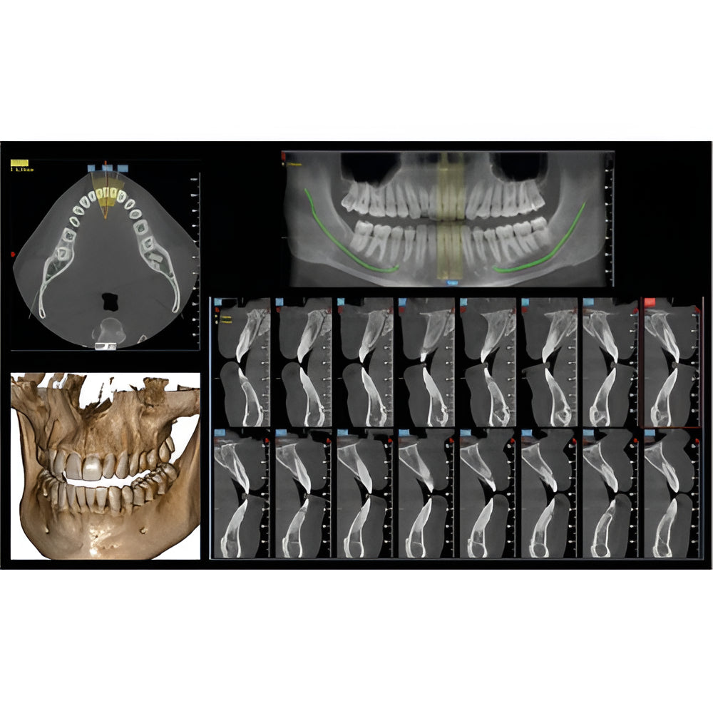 NewTom Go 2D+3D+CBCT with PC, Software, Warranty