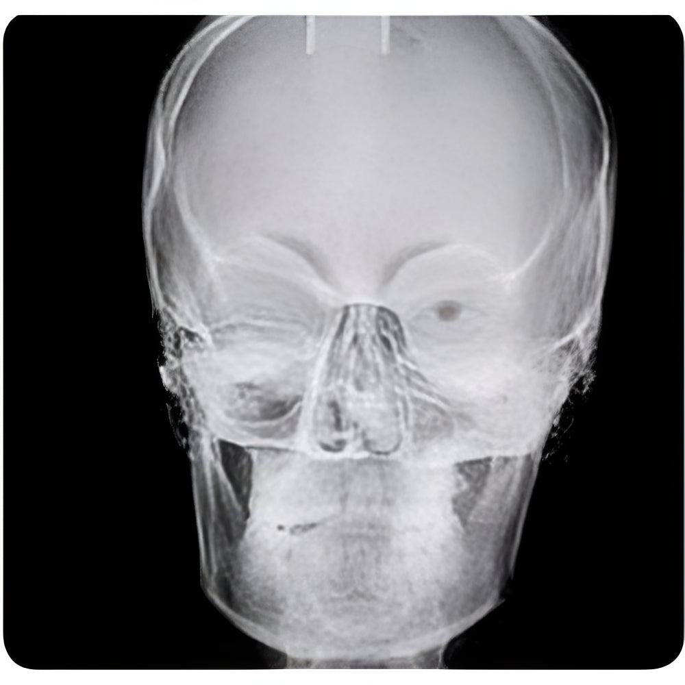 NewTom Giano Pan + Ceph + CBCT (11x8 FOV)