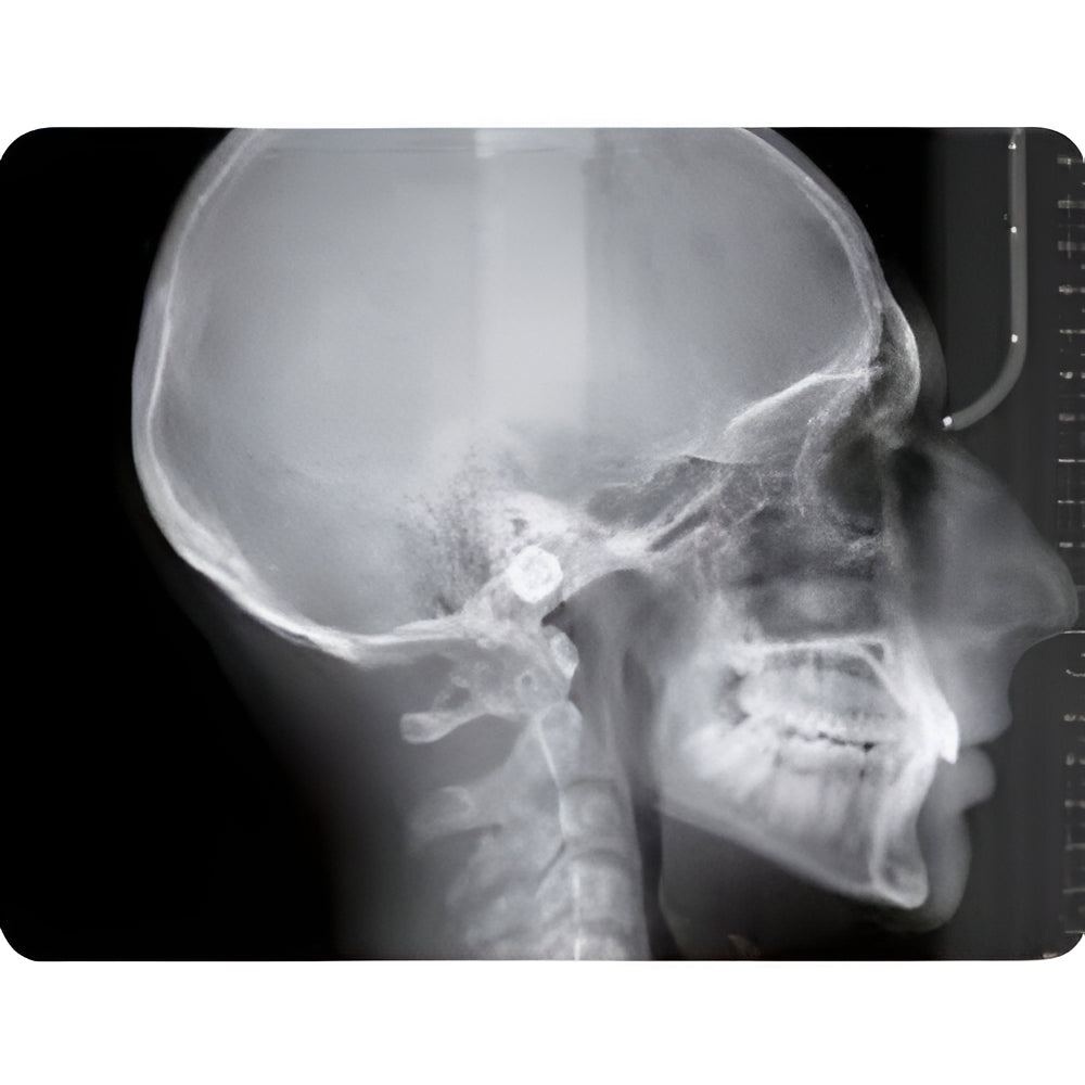 NewTom Giano Pan + Ceph + CBCT (11x8 FOV)