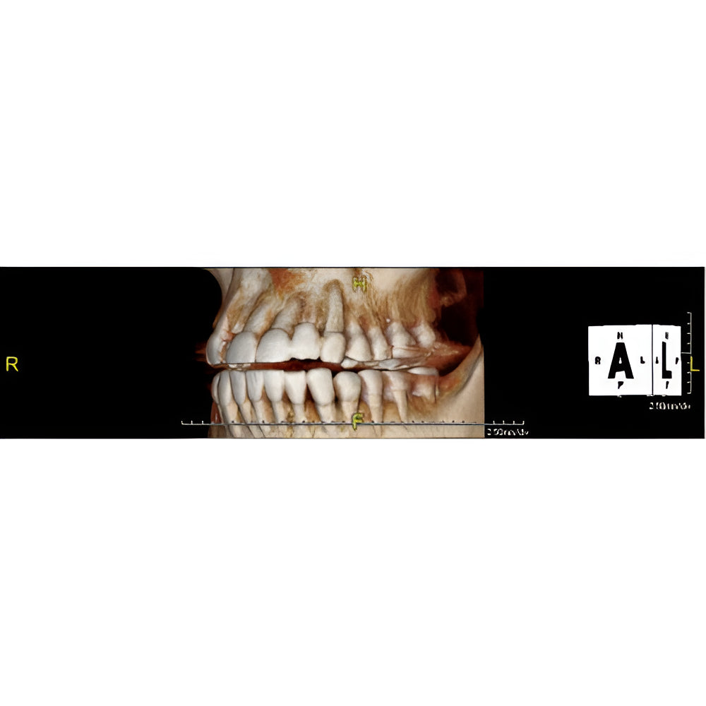 PreXion Excelsior Pan + CBCT (15x8 FOV)