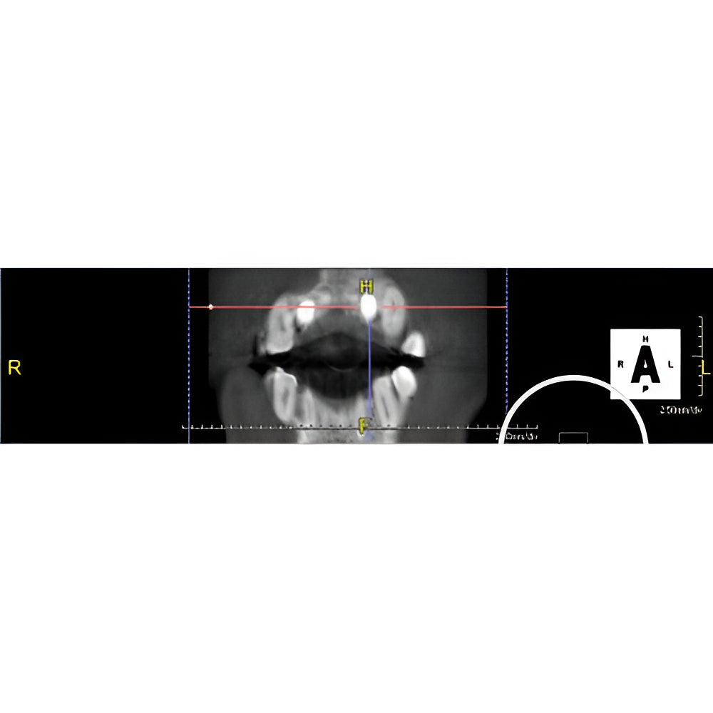 PreXion Excelsior Pan + CBCT (15x8 FOV)