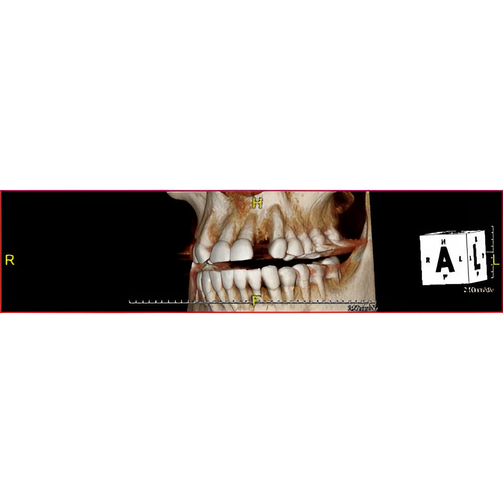 PreXion Excelsior Pan + CBCT (15x8 FOV)