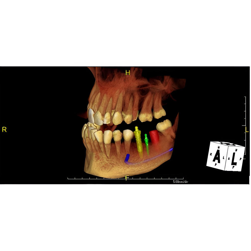 PreXion Excelsior Pan + CBCT (15x8 FOV)