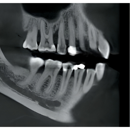 PreXion Eclipse XP77 Pan + CBCT (11.3x7.5 FOV)