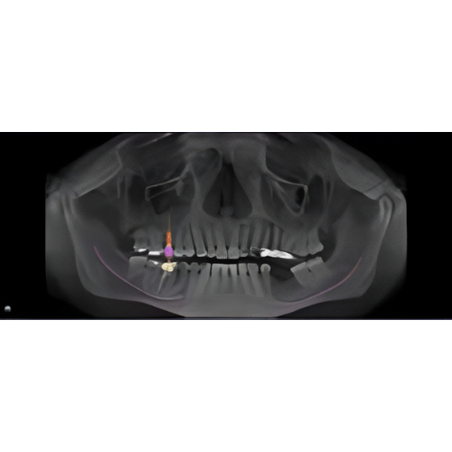 Sirona Galileos Comfort CBCT (15x15 FOV)