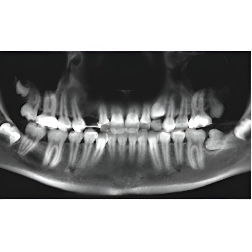 i-CAT FLX V17 Pan + CBCT (23x17 FOV)