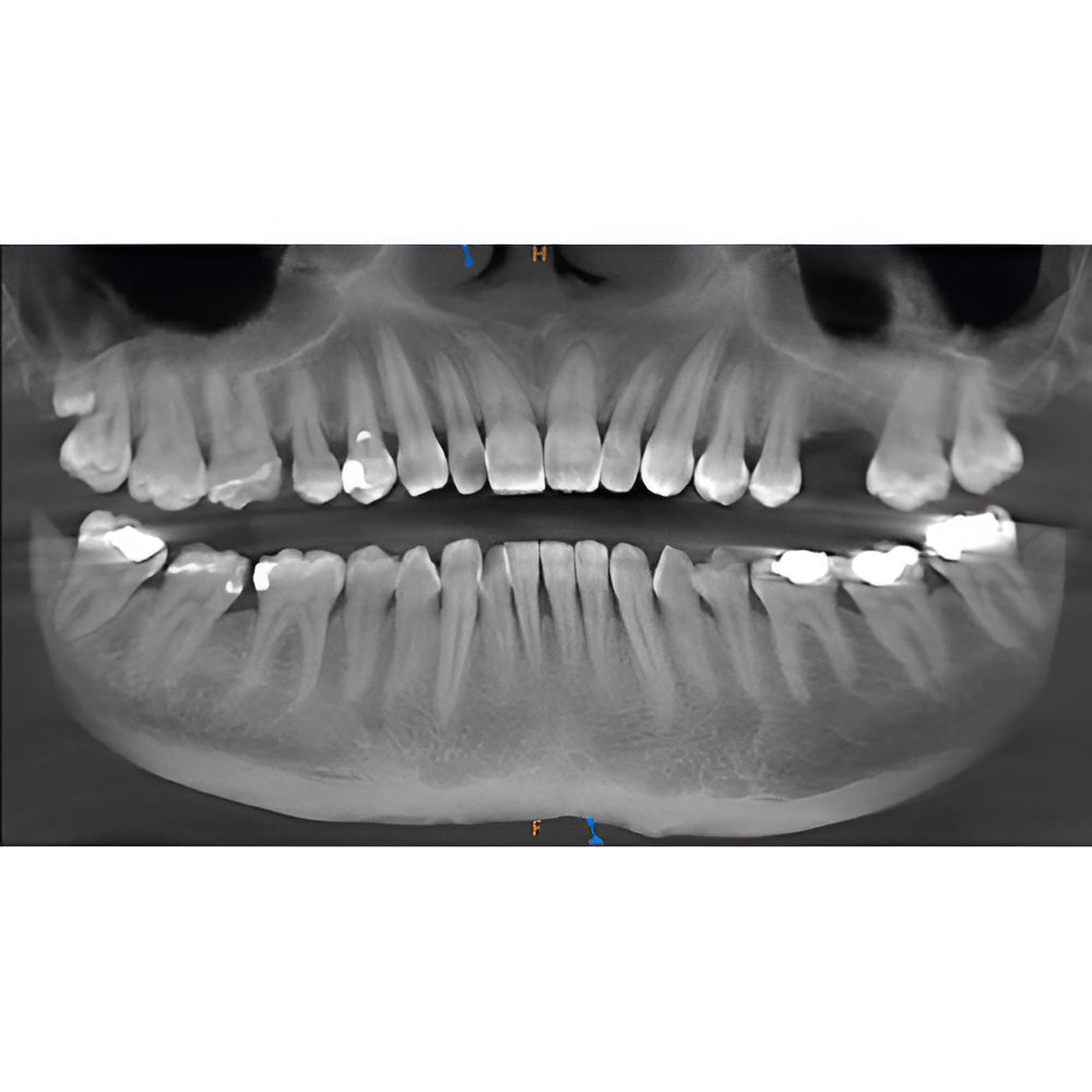 i-CAT Next Gen Pan + CBCT (23x17 FOV)