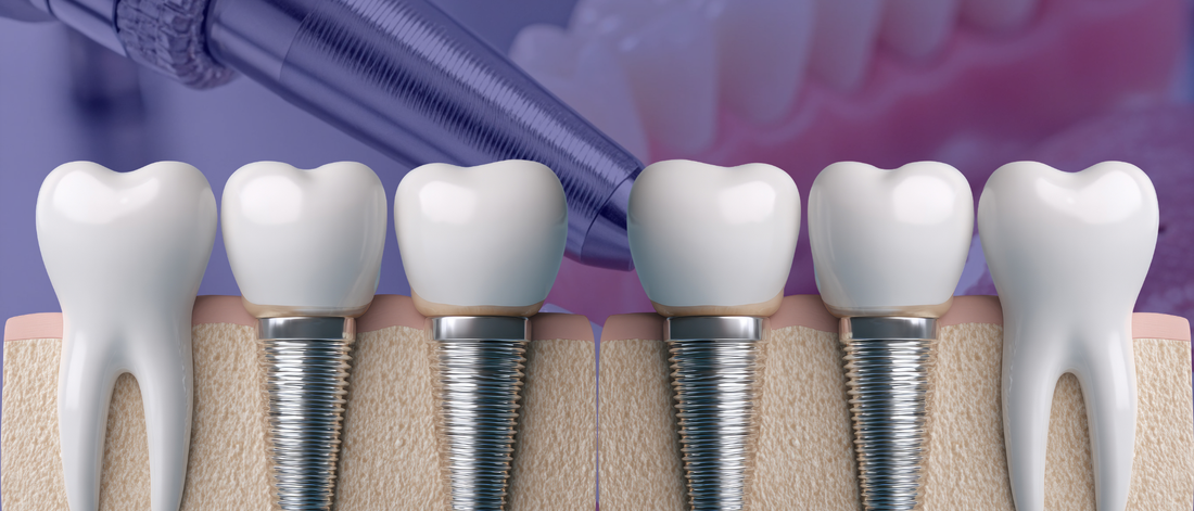 Why CBCT Scans Are Essential for Safe and Predictable Implant Planning