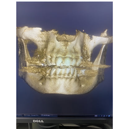 Acteon XMind Trium Pan + CBCT (11x8 FOV)