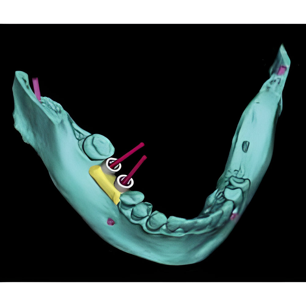 Acteon XMind Trium Pan + CBCT (11x8 FOV)