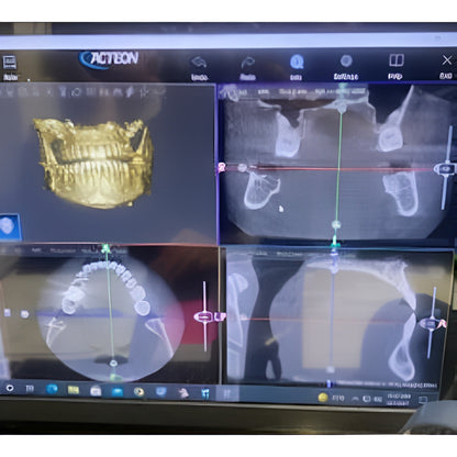 Acteon XMind Trium Pan + CBCT (11x8 FOV)