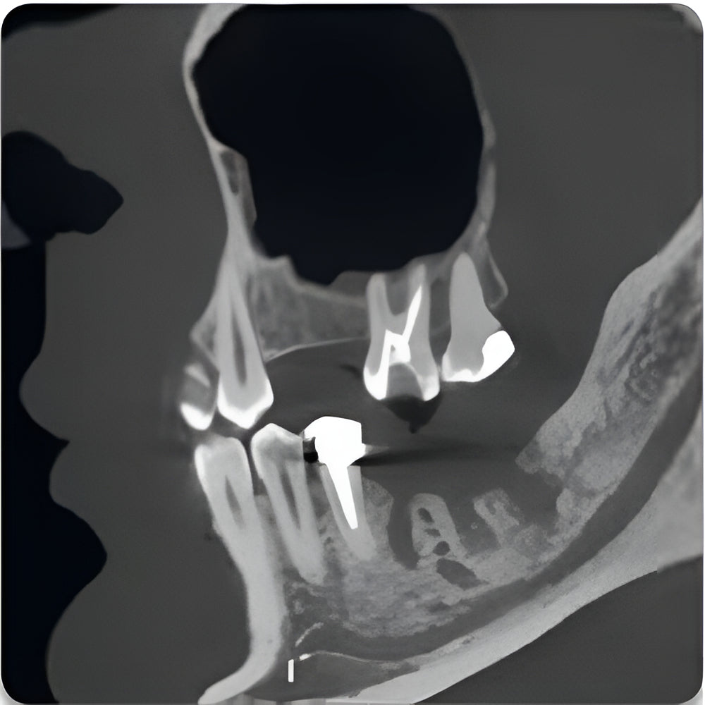 Acteon XMind Trium Pan + CBCT (11x8 FOV)