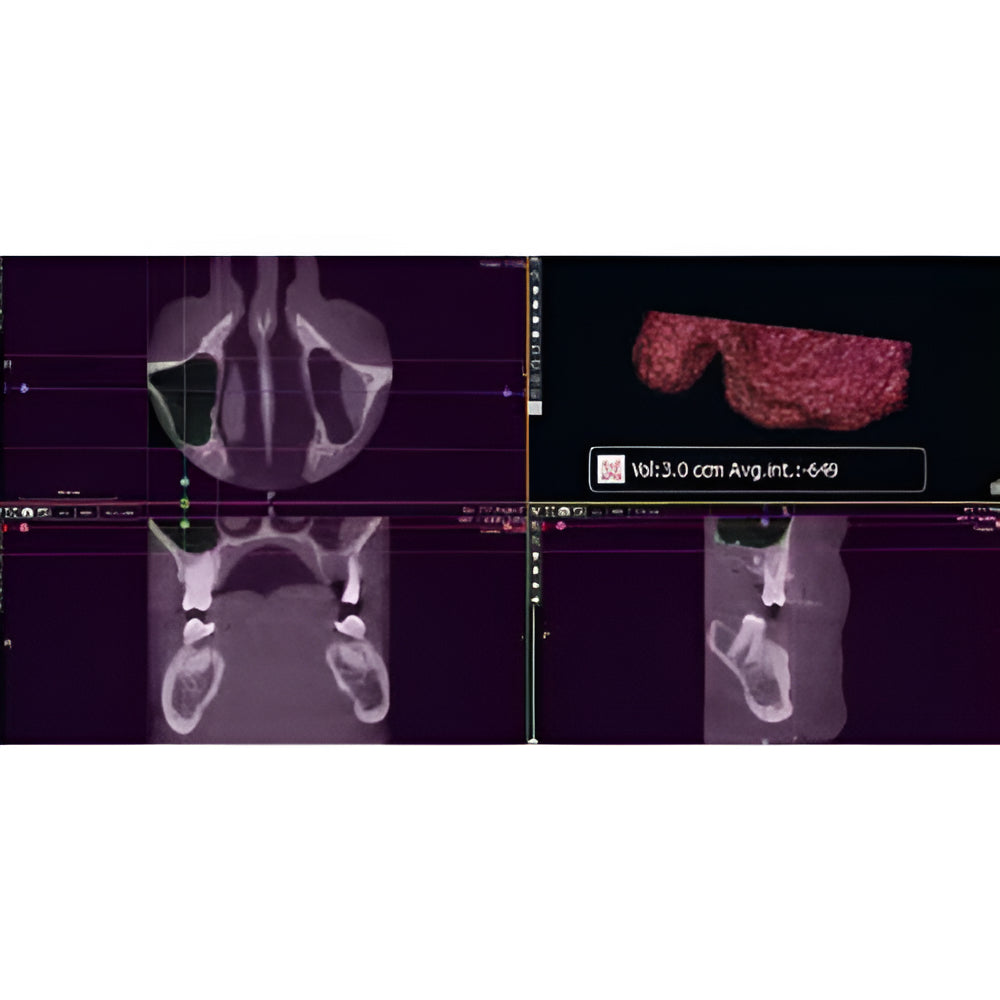 Acteon XMind Trium Pan + CBCT (11x8 FOV)