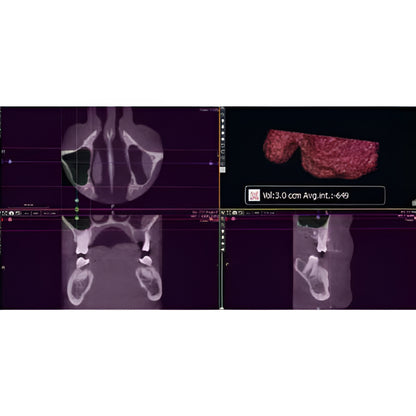 Acteon XMind Trium Pan + CBCT (11x8 FOV)