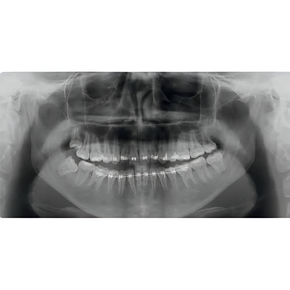 Acteon XMind Trium Pan + CBCT (11x8 FOV)