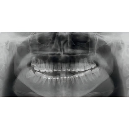 Acteon XMind Trium Pan + CBCT (11x8 FOV)