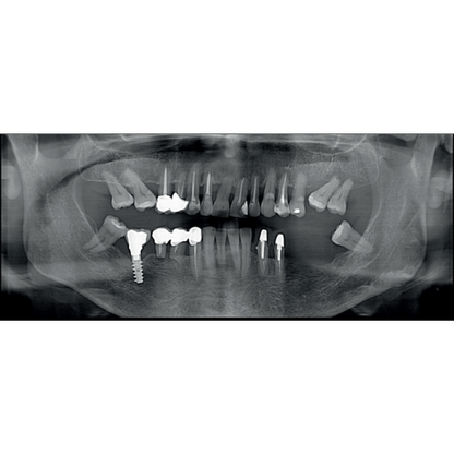 Acteon XMind Optima Pan + CBCT (12x10 FOV) with PC, Software, Installation, Shipping and Warranty