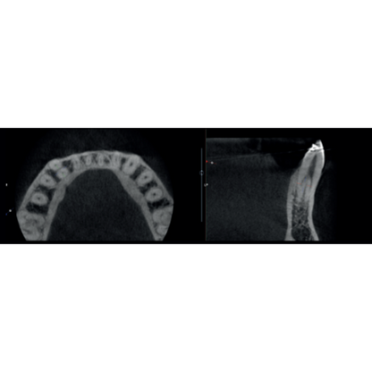 Acteon XMind Optima Pan + CBCT (12x10 FOV) with PC, Software, Installation, Shipping and Warranty