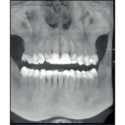 Acteon XMind Optima Pan + Ceph + CBCT (17x12 FOV) with PC, Software, Installation, Shipping and Warranty