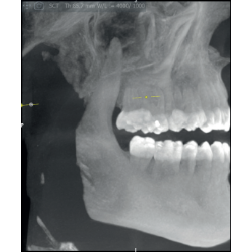 Acteon XMind Optima Pan + Ceph + CBCT (17x12 FOV) with PC, Software, Installation, Shipping and Warranty