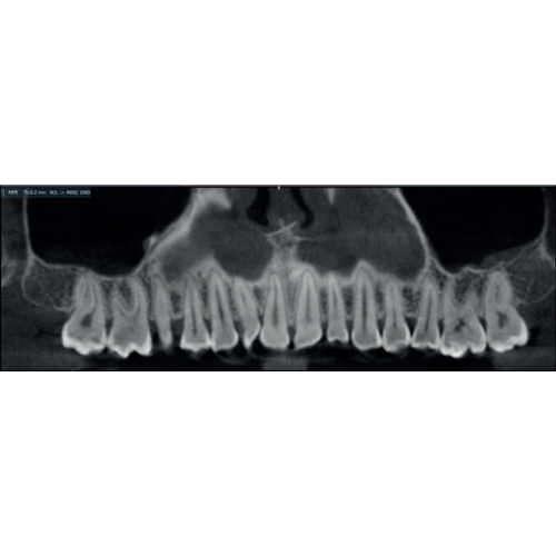 Acteon XMind Optima Pan + CBCT (12x10 FOV) with PC, Software, Installation, Shipping and Warranty