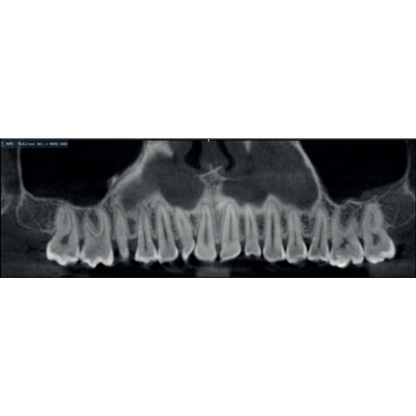 Acteon XMind Optima Pan + CBCT (12x10 FOV) with PC, Software, Installation, Shipping and Warranty
