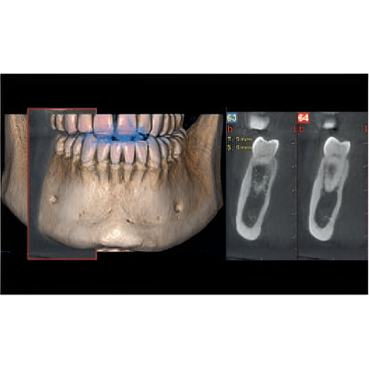 NewTom Giano HR Prime Pan + CBCT (10x8 FOV) with PC, Software, Installation, Shipping and Warranty