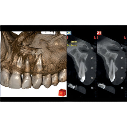 NewTom Giano HR Prime Pan + CBCT (10x8 FOV) with PC, Software, Installation, Shipping and Warranty