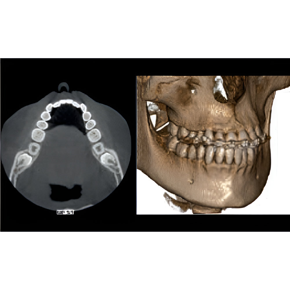 NewTom Giano HR Prime Pan + CBCT (10x8 FOV) with PC, Software, Installation, Shipping and Warranty