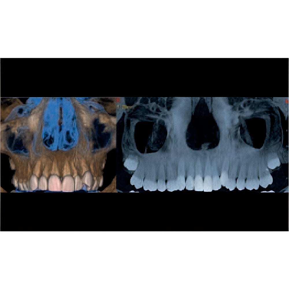 NewTom Giano HR Prime Pan + CBCT (10x8 FOV) with PC, Software, Installation, Shipping and Warranty