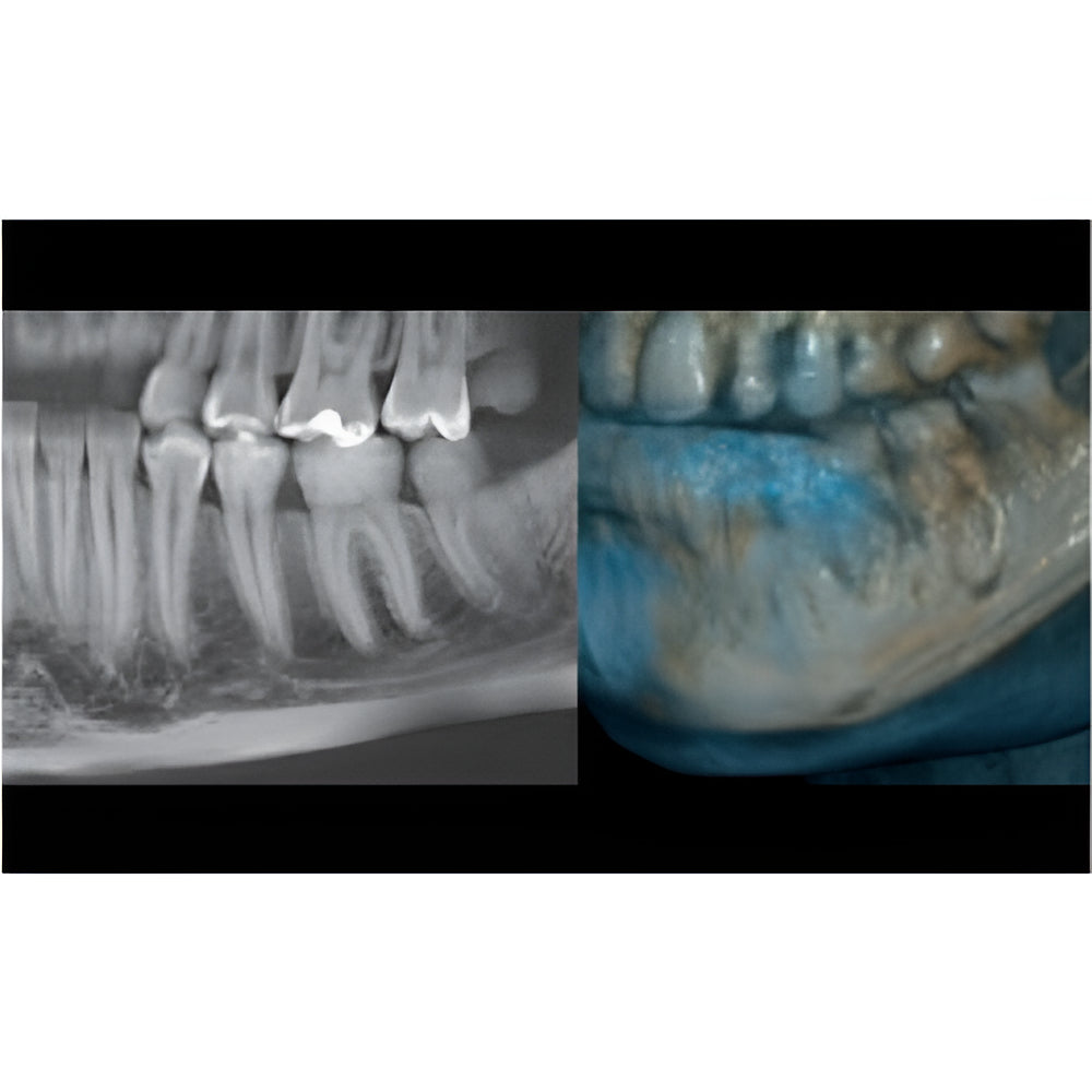 NewTom Giano HR Prime Pan + CBCT (10x8 FOV) with PC, Software, Installation, Shipping and Warranty