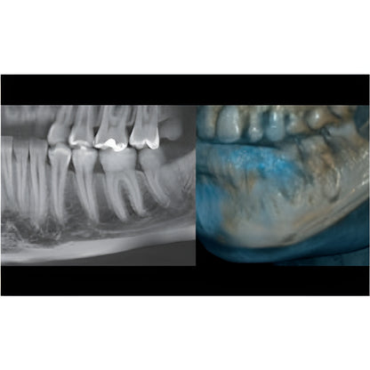 NewTom Giano HR Prime Pan + CBCT (10x8 FOV) with PC, Software, Installation, Shipping and Warranty