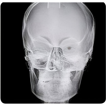 NewTom Giano Pan + Ceph + CBCT (11x8 FOV)